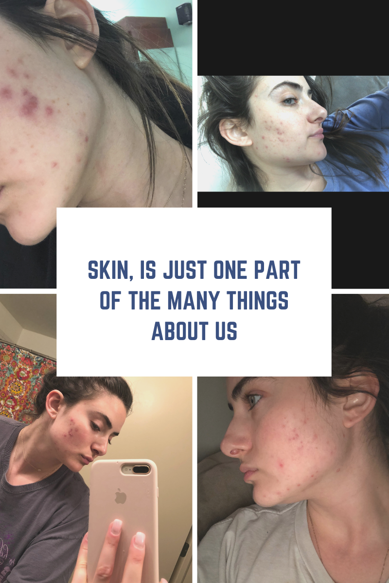 Graphic showing woman with hormal acne before cbd | The Day My Hormonal Acne Moved Out
