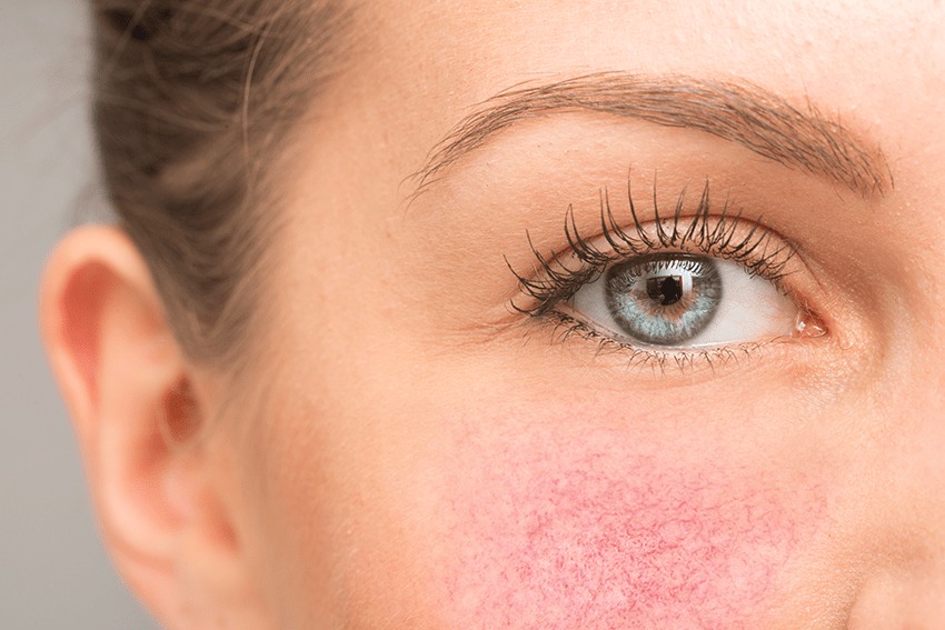 image of a closeup of a woman with rosacea for the blog about Finding Better Relief: 3 CBD Creams for Rosacea and Their Potential Benefits